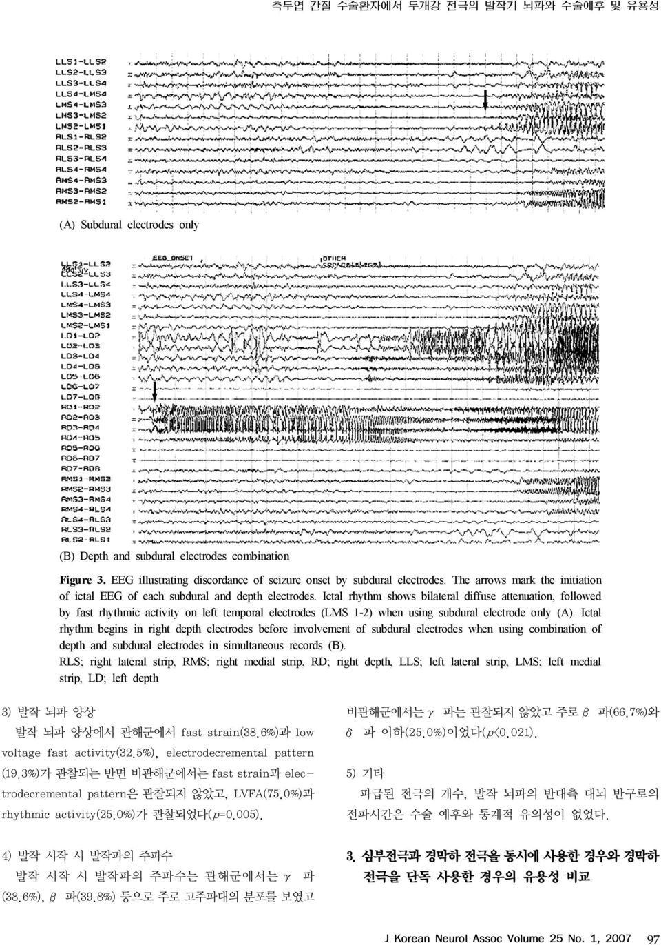 Ictal rhythm shows bilateral diffuse attenuation, followed by fast rhythmic activity on left temporal electrodes (LMS 1-2) when using subdural electrode only (A).