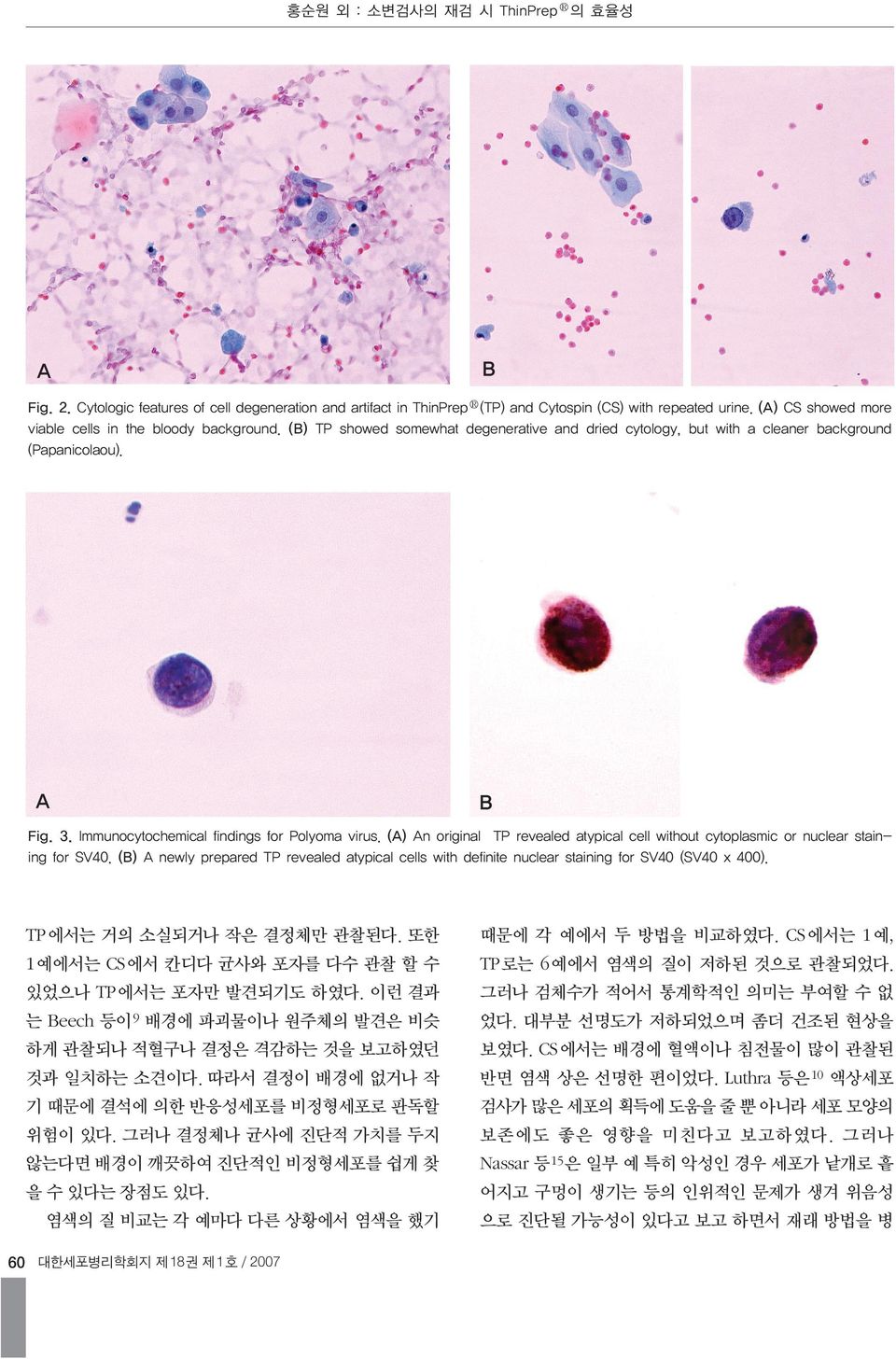 Immunocytochemical findings for Polyoma virus. (A) An original TP revealed atypical cell without cytoplasmic or nuclear staining for SV40.