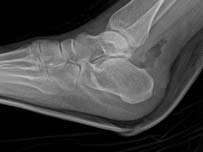 Achilles tendon Midportion Achilles tendinopathy 달리기선수 : 일반인에비해아킬레스건파열의위험도는 15 배높고, 단순건병증의위험도도 30 배가넘는다.