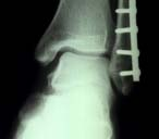 Anterior Impingement syndrome (AIS) Radiologic evaluation X-ray: Anterior spur 전방골극 McDermott grading categories Preop. Postop.