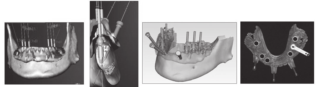 ISSUE 6 디지털치과의료기기의기술및산업동향 컴퓨터기반임플란트시술 (Computer-aided implant dentistry) - 수술전에 CT(Computor Tomography)