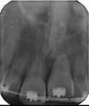 Crown exposure after 1 month Fig. 5.