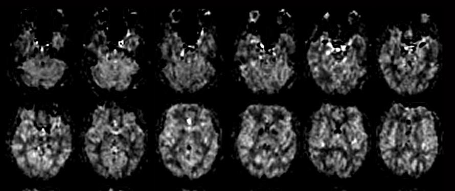 Whole Brain ASL Perfusion MRI at