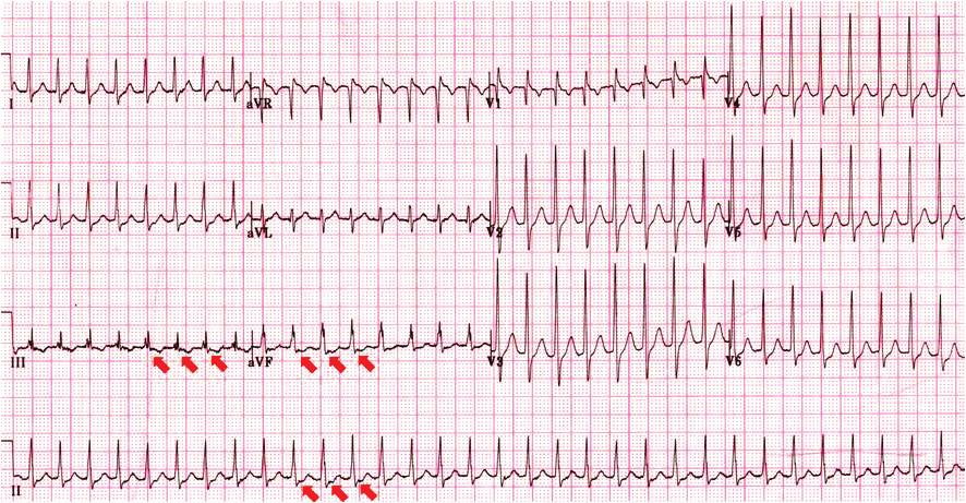 Figure 2. An ECG of atrioventricular nodal re-entrant tachycardia (AVNRT). ECG shows regular tachycardia with narrow QRS (rate=195 bpm).
