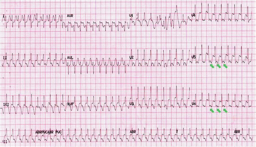 Figure 3. An ECG of atrioventricular re-entrant tachycardia (AVRT). ECG shows regular tachycardia with narrow QRS (rate=234 bpm).