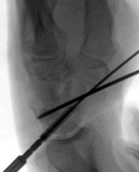 (C) A standard cannulated Acutrak screw, 4 mm shorter than the length of the scaphoid, was inserted. 14예를대상으로연구를시행하였다.