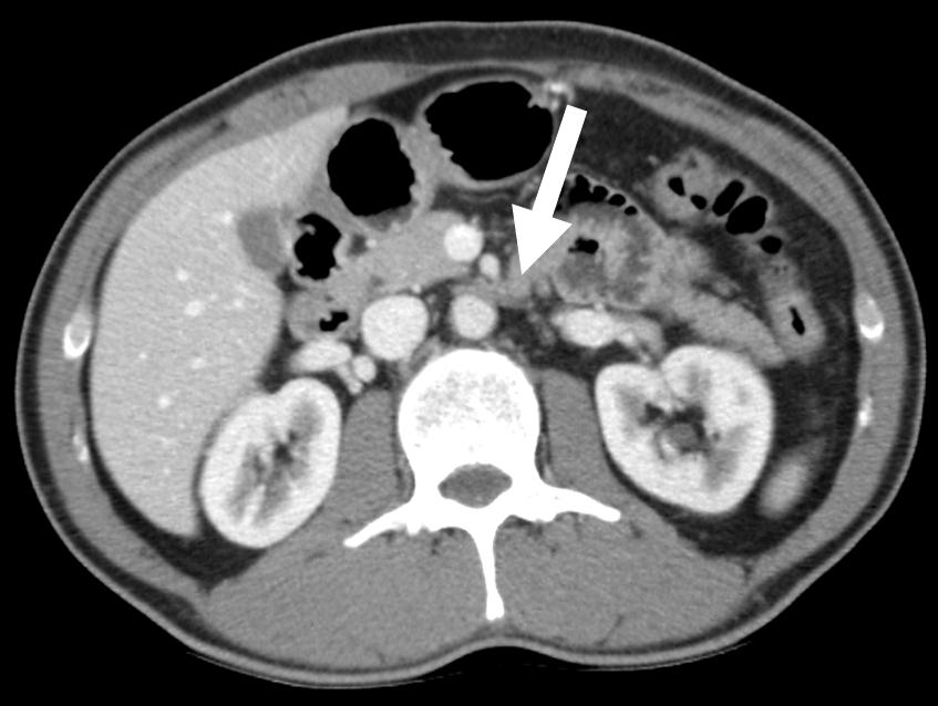 Fig. 3. Computed tomography of left paraaortic recurrence. (A) A nodal recurrence 27 months after orchiectomy in the left paraaortic area (arrow).