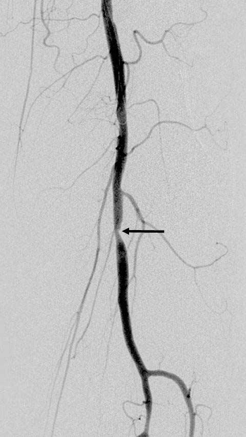 대한영상의학회지 2009;61:31-38 A B C Fig. 3. A 58-year-old man with diabetic ulcer in left foot. A. Preprocedure angiogram showed an eccentric stenosis in the left popliteal artery (P2 segment, arrow). B. A 5 mm 20 mm cutting balloon was used to treat this lesion.