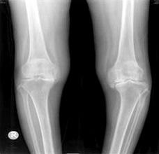 (C) Whereas sagittal tibial δand femoral γangles were measured on lateral knee radiographs with the patient lying and the knee flexion. 술전관절운동범위는평균 106.4 o (90 o -115 o ) 였고 B군의술전관절운동범위는평균 107.