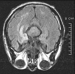 Dynamic Changes of MRI after Seizures Spike, F8 Figure 3. MRI and EEG findings in patient 3.