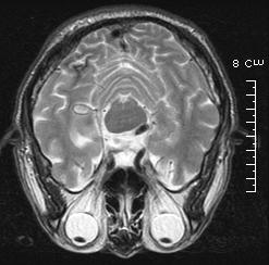 : Initial diffusion-weighted MR images reveal increased signal intensity in the left frontoparietal cortical and part of the