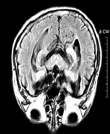 전신성강직근간대성발작 (generalized tonic-clinic seizure, 이하 GTC) 을보였던환자 3에서는환자 1에서와유사하게우측해마를포함한내측관자엽 (mesial temporal lobe) 에서 FLIR 와 T2WI 에서고신호강도를보였고조영증강 (gadolinium enhancement)