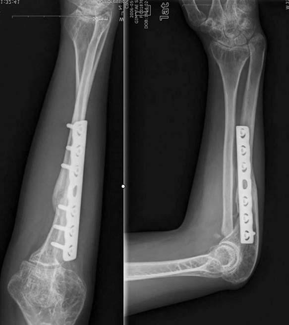 Preoperative radiographs of case 2 show nanunion of the ulnar fracture with dislocation of radial head 18 months after initial injury. Fig. 6.