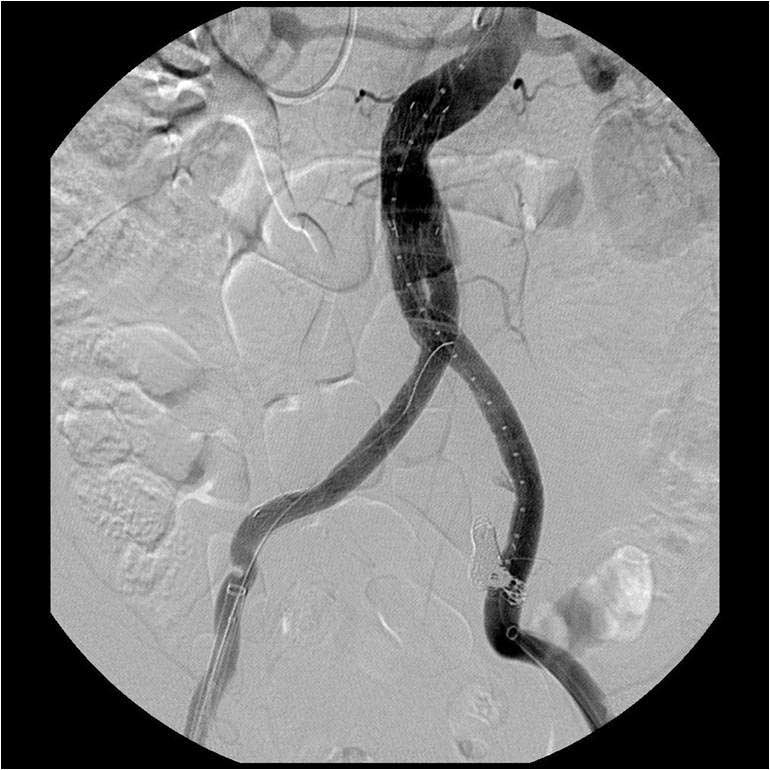 Angiographic image shows two aneurysms involving both common iliac arteries.