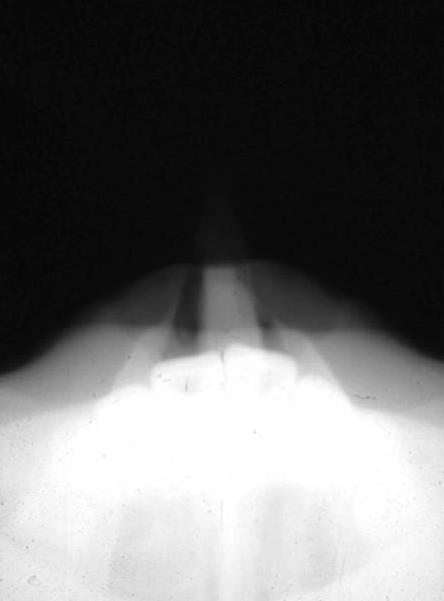 Nasal bone Tangential Lateral Septal