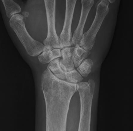 Wrist PA : wrist 밀착을위해손을구부린다. trapezoid capitate hamate 2.