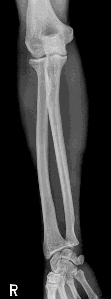 Forearm AP lateral epicondyle Radial tubercle medial epicondyle : 손바닥을회외 (Supination) 시키고어깨-팔꿈치-손목이같은높이. 2.
