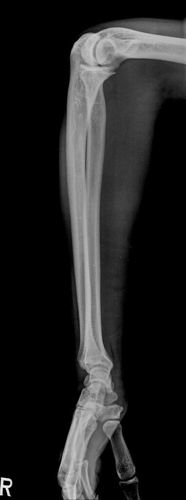 Forearm lateral Olecranon : 어깨 - 팔꿈치 - 손목이같은높이.