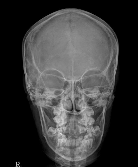 Skull AP Sagittal suture : MSP 필름. OML 필름. : Nasion. 수직입사.