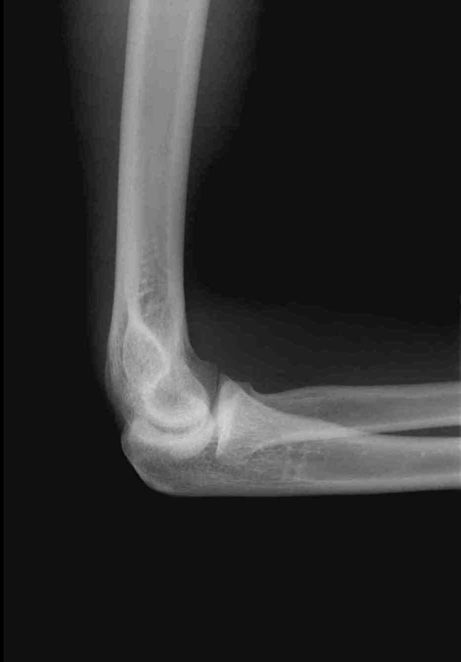 Elbow Lateral (forearm lateral 과동일 ) : 어깨 - 팔꿈치 - 손목이같은높이. Elbow joint 90 O Coranoid process 2.