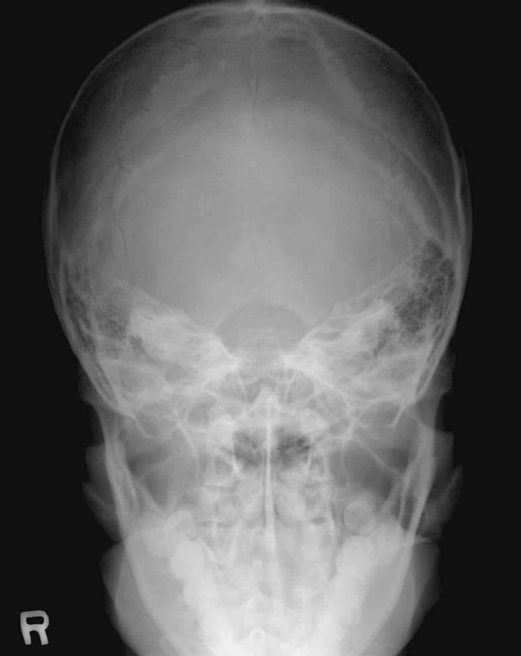 Skull AP Axial (Towne, Grashy Method) OML 수직 IOML 수직 : OML 필름. IOML 필름. Occipital bone : Towne Glabella 3 inch 위.