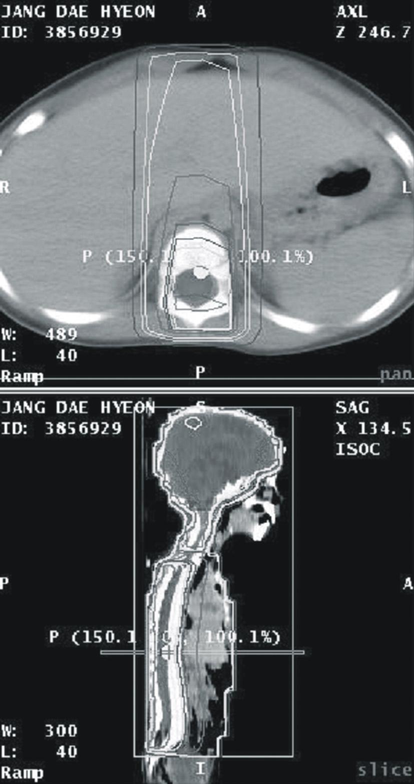 조재호 외 10인 수모세포종의 전두엽하방 재발 부터 9월까지 시행하였다. 방사선치료 종료 후 16개월, 항 30 Gy였다. 두 번째 환자는 생후 년 개월 된 환아로 약 암화학요법 종료 후 7개월에 두통을 주소로 다시 내원한 1개월 간의 심한 구토를 증세로 내원하여 시행한 MRI에서 환자의 MRI상 4.0 4.5 3.