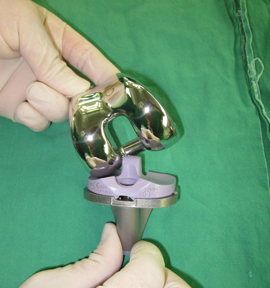 Song EK Seon JK Park KS Yoon TR Figure 1. Posterior-stabilized prosthesis showing that the postand-cammechanism offers no restraint to varus or valgus stability.