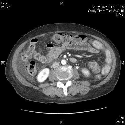 복수를동반한간경변환자의生肝健脾湯치험 1 례 (2)Ursa2T#2 (3)Revanex1T#1 (4)Amodipine1T#1 (5)DiabexXR10001T#1 (6)Glimepid21T#1 (7)MGO 3T#3 2)