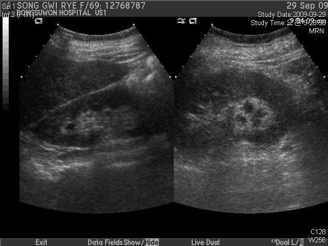 1) 복부둘레변화 :3일마다아침식전일정한시간에측정함 (Fig.1). 2)Lab 변화 (Table1) 3) 복부CT 및초음파검사비교 (Fig.2~4) Fig.2.AbdomenCT(2009.10.