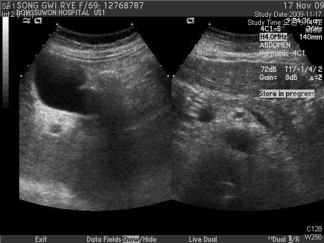 Fig.4.Abdomensono(2009.11.17):L/C,NoAscites, SmalL/N-peripancreatic Ⅳ.