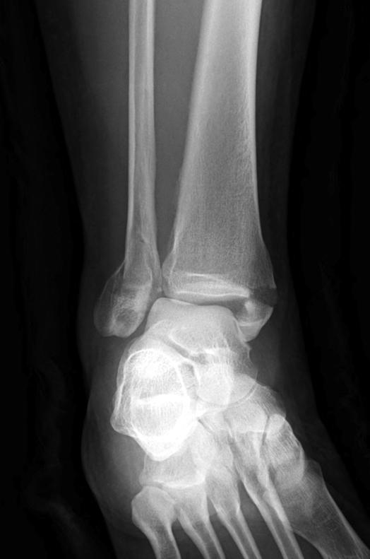tibiofibular ligament. The preoperative distal tibiofibular clear space was measured to be 6.5 mm.