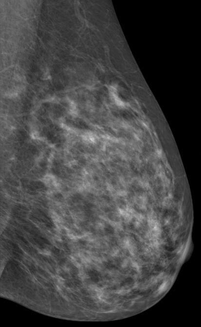 Mammographic Findings Number of Cases Radiologists (n = 141) Residents (n = 61) Pre-Camp Post-Camp Mass or asymmetry 13 56.7 (18.0 88.5)* 56.3 (8.5 91.5) 86.6 (50.4 99.3) Microcalcifications 4 70.