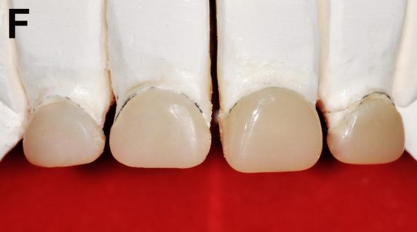 3D scanning model (upper) and stent for strip crown designed by 3D imaging software (lower).