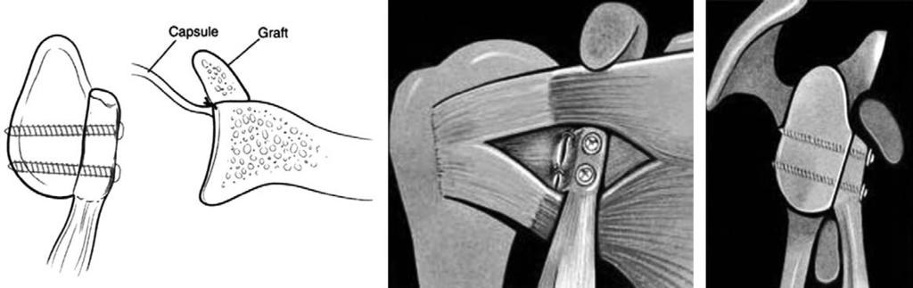 Shoulder Arthroscopy 전술했듯이, 골결손이큰환자에서는오구돌기이전술이나장골이식과같은골이식이요구된다 4,5,8,31). 최근엔오구돌기이전술의일종인 Bristow-Latarjet 수술법이주로쓰인다 (Fig. 3).