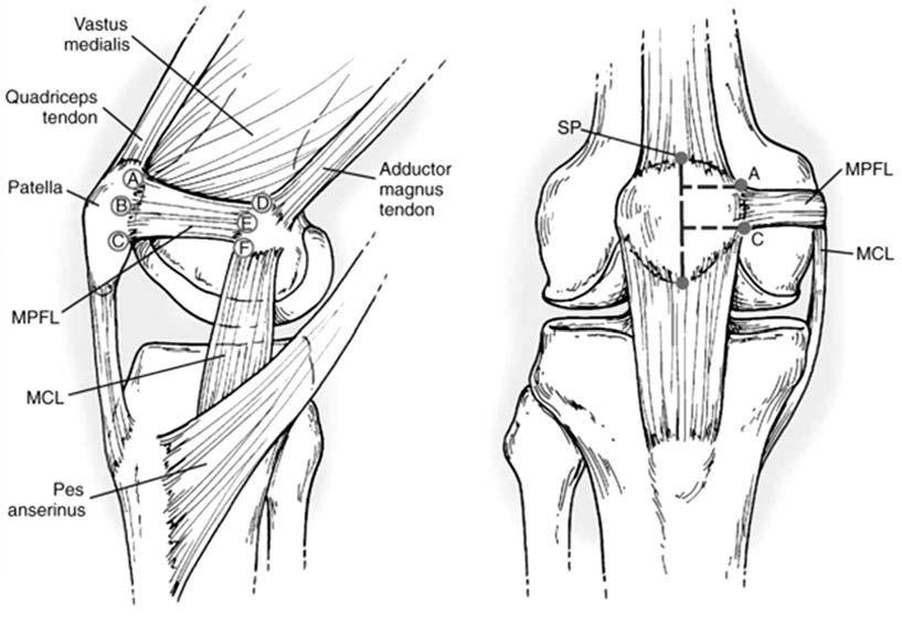 Knee Arthroscopy & Osteotomy A Fig. 2. (A) Anatomy of medial patellofemoral ligament (MPFL) and medial aspect of knee, showing points A through F on MPFL.