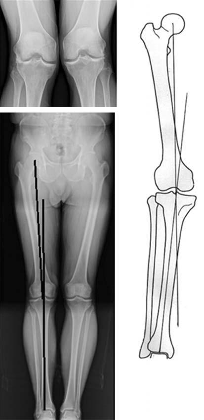 Knee Arthroscopy & Osteotomy 병변이있는경우슬관절의절골술전에먼저확인하고해결해야한다. 수술적응증 (surgical indication) 환자의나이와활동도는근위경골절골술에비해유합시간과부분체중부하기간이길기때문에보다신중하게선택되어야한다.