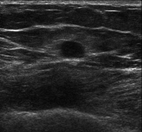 Right craniocaudal () and mediolateral oblique mammography () show about 1.