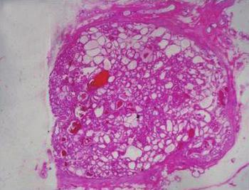 Invasive ductal carcinoma arising in intraductal papilloma (upper center, Fig. 2).