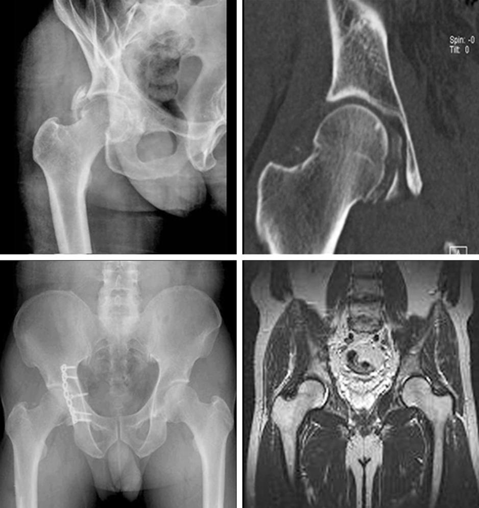 외상성고관절후방탈구에동반된대퇴골두골절의치료 C D Fig. 3. (, ) 46-year-old male sustained Pipkin type IV fracture of hip.