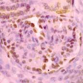 () In mature glomeruli, nephrin expression at cell body is decreased and staining pattern