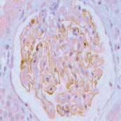 사구체질환에서 nephrin, GLEPP1 및 WT-1 25 D D Fig. 4. Glomerular epithilial cell protein-1 (GLEPP1) expression in glomerular disease.