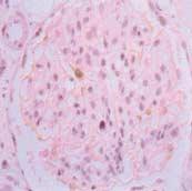 () normal-looking glomerulus from the patient with minimal lesion shows focally decreased expression of GLEPP1.