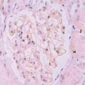(D) glomerulus from the patient with membrnaous nephropathy shows focal loss of GLEPP1 staining. Table 2.