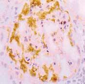 () histologically normal glomerulus from minimal lesions shows wide decrease and loss of nephrin expression.
