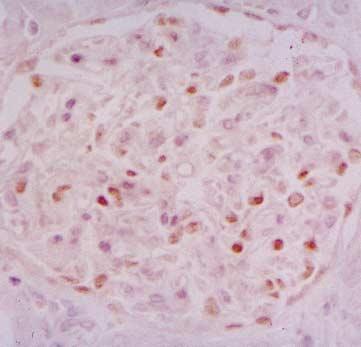 26 Fig. 6. WT-1 expression in glomerular disease. () glomerulus from control kidney shows strong nuclear staining of WT-1 protein.