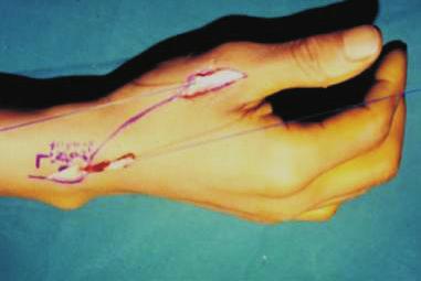 (C) The free tendon graft with Palmaris longus tendon was done with Pulvertaft method with wrist in neutral position and thumb extended.