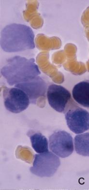 ytochemical staining of bone marrow aspiration.