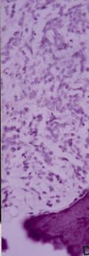 1), 세포화학염색에서 PS에양성과 myeloperoxidase와 chloroacetate esterase에서음성반응을보였다 (Fig. 2). 골수천자의면역조직화학염색상신경원특이성에놀라제 (NSE), chromogranin, synaptophysin에대해양성과 vimentin, MI2과 mixed keratin에대해서는음성소견을보였다 (Fig. 3).