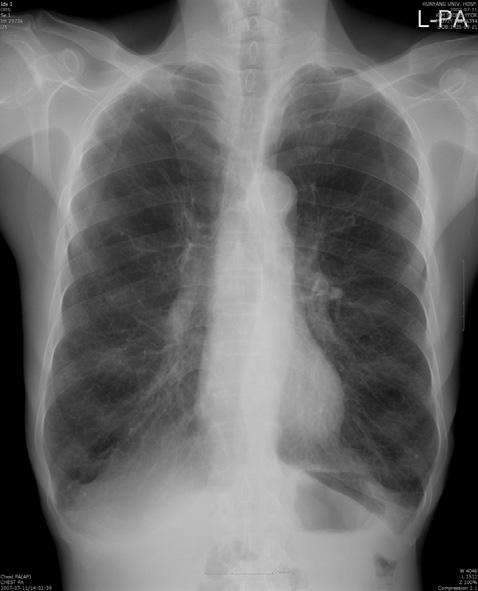 GOLD : Mild Global Strategy f Diagnosis, Management and Prevention of COPD Classification of Severity of Airflow
