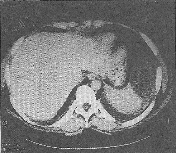 - 전신성홍반성낭창환아에서발생한단독성비장경색 1 례 - Fig.1.TheabdominalCT showed awedgeshaped, low atenuated lesion in theanteriorportion ofthespleen. Fig.2.